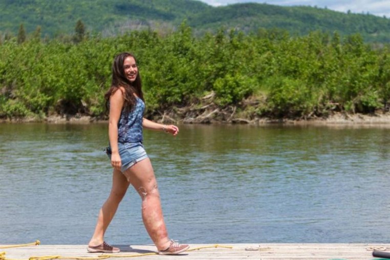 Teen With Shockingly Swollen Leg Poses in a Bikini to Inspire Body Confidence